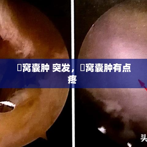 腘窩囊腫 突發(fā)，腘窩囊腫有點疼 