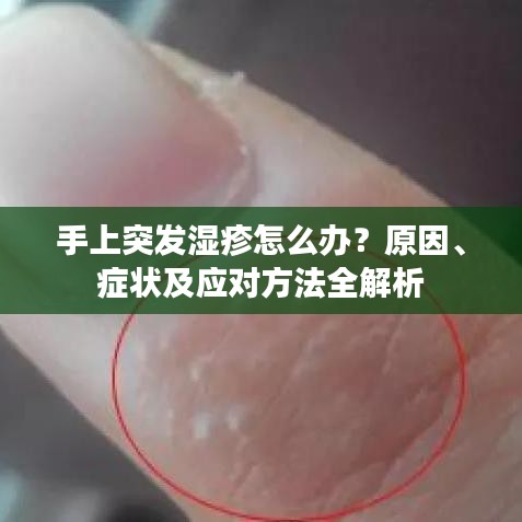 手上突發(fā)濕疹怎么辦？原因、癥狀及應(yīng)對方法全解析